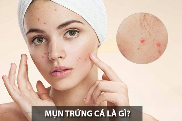 Trị mụn trứng cá