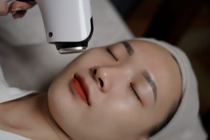 Triệt lông mặt