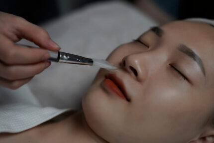 Triệt lông mép