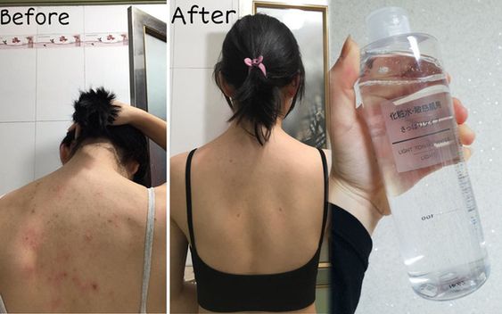 Kem trị mụn lưng 