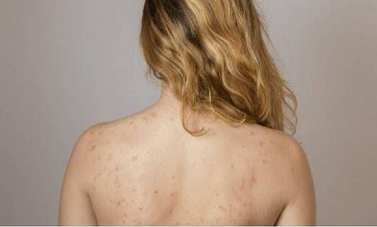 Nguyên nhân gây ra mụn trên da 